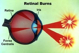 Queimadura de retina com dano permanente por cicatriz, resultante de olhar diretamente para a bola de fogo
